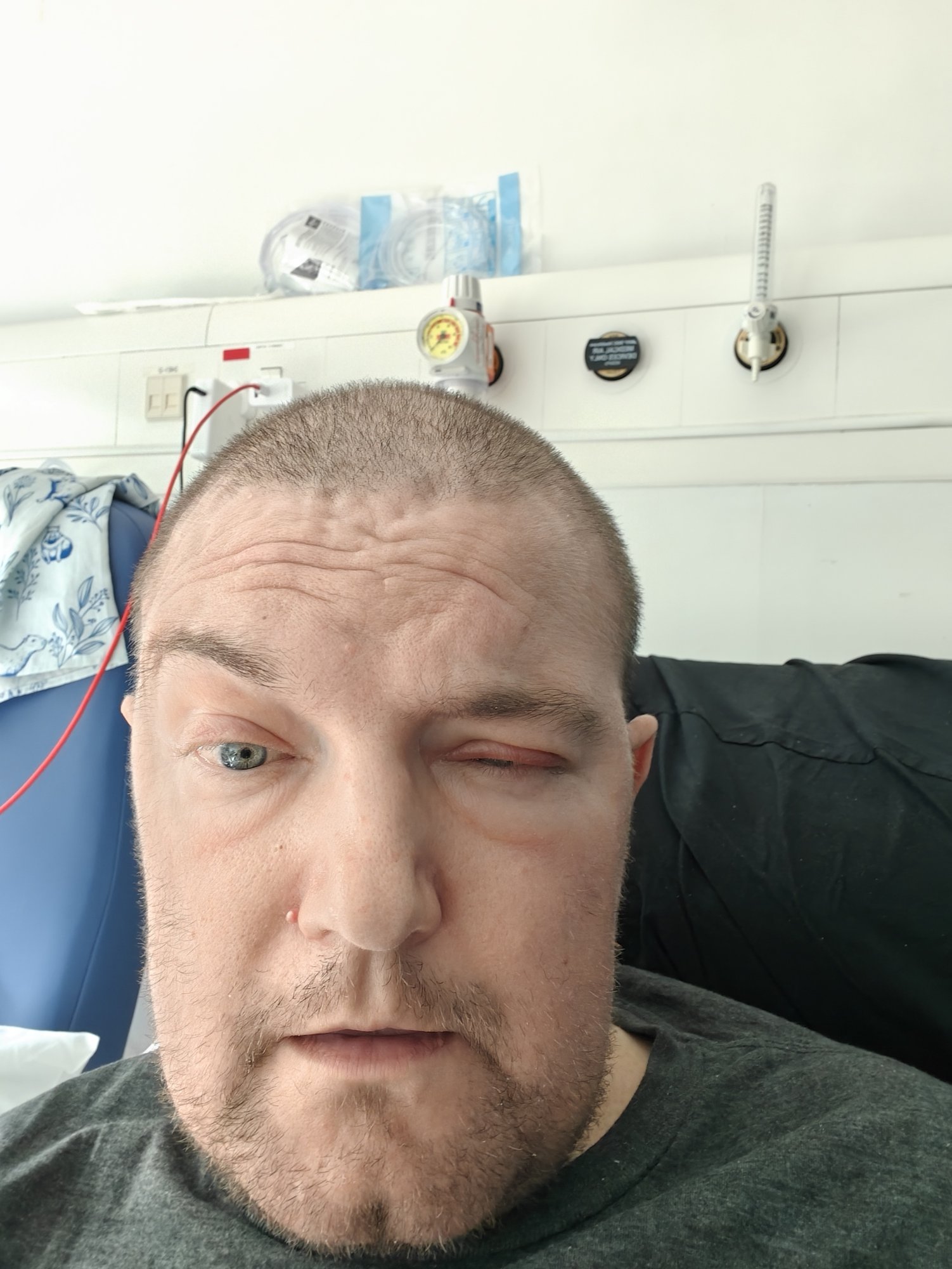 A picture of me - Martin Eve, a 40-year old white man with very short clipped hair and some facial hair - with one eye horribly swollen and red and closed up.